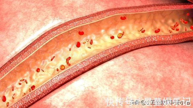 降脂|既能抗凝又能降脂稳定斑块？聊一聊常用的中成药——通心络胶囊