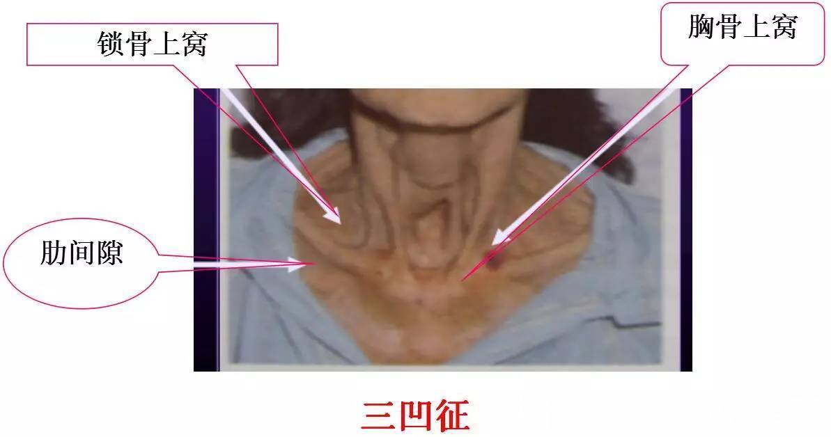 接种疫苗|世界肺炎日：感冒和肺炎，傻傻分不清楚？医生教你从这6点来区分