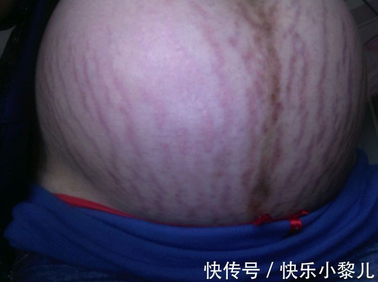 西瓜纹|8个月孕妇抱着西瓜拍孕妇照,看到“西瓜纹”的肚皮,丈夫沉默了