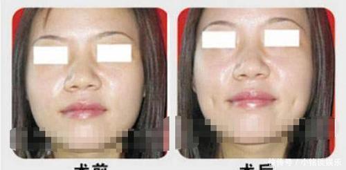 真的|整容界又现“黑科技”,酒窝也有人工的,网友:全身还有真的吗?