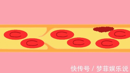 小动作|血栓,就像游走在血管里的幽灵!它竟然最怕这5个小动作!