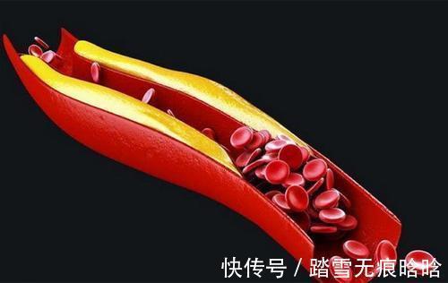 热量|高脂血症容易盯上谁？谨记预防高血脂的“7要点4要素”