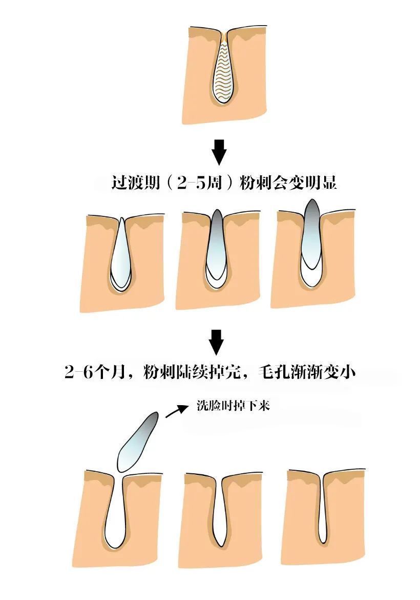 皮肤|失策失策，去闭口就不该听他们的
