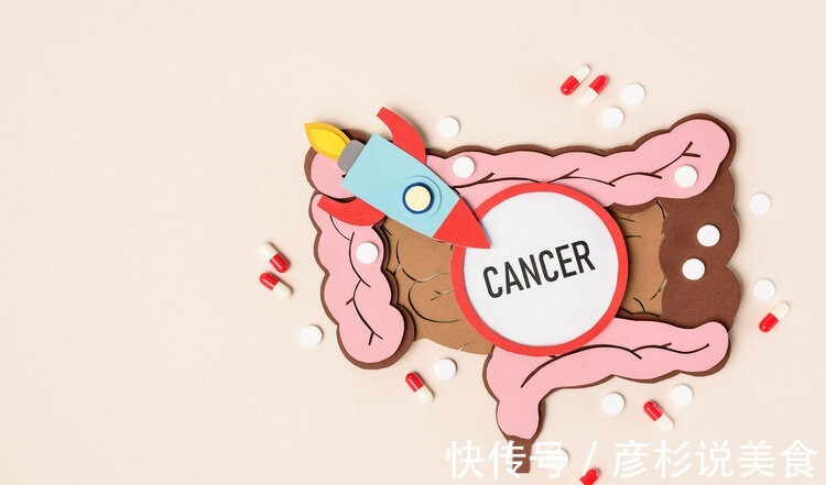 肠癌|肠癌来临前,大便可能会有3种异常,劝告4类高危人群需要警惕