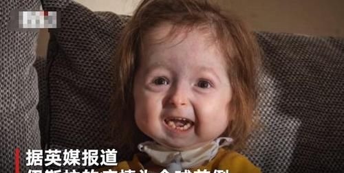 疾病|全球首例!2岁女童却有80岁的脸,网友:希望能像本杰明巴顿一样