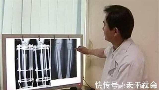 孩子|还记得6年前的李亚诺吗?花16万断骨增高7厘米,现状让担忧