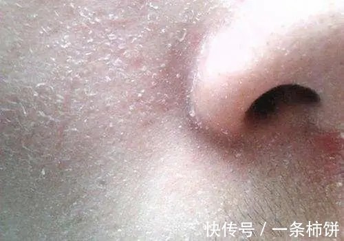 角质层|告别!九个闭口形成的原因!好皮肤才是仙女的本钱来一起变美吧