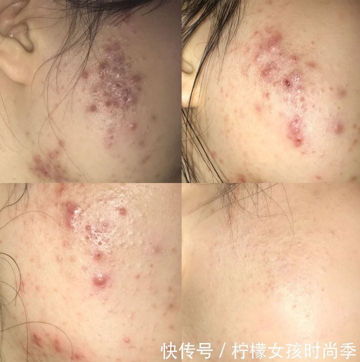 水杨酸|男女颜值杀手的罪魁祸首——痘痘，教你4招摆脱痘痘，养成水光肌