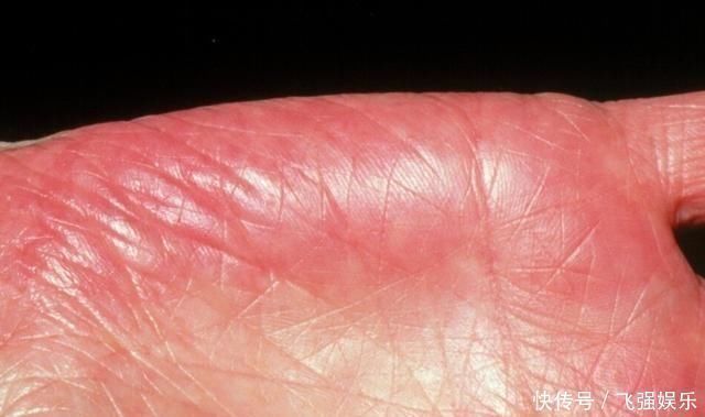 养肝|养肝“冠军”找到了，不是菊花，开水里丢一把，肝病靠边站