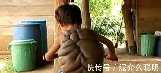 肉瘤|8岁男孩背上长“乌龟壳”，得知真相后，旁人感到心疼不已
