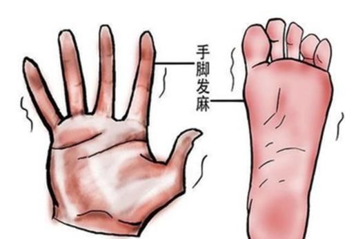 手脚麻木|手脚麻木，是哪里发出的预告？