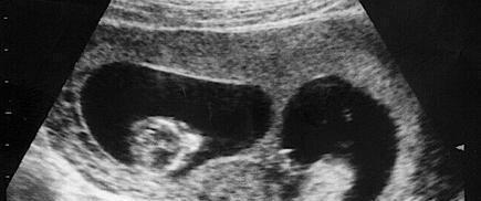 胡女士|38岁高龄产妇，生下女儿3天后又进入产房，网友世上还有这回事