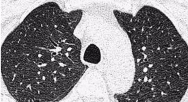 结节|如何让你的肺结节变小甚至消失？听听医生怎么说