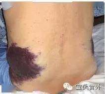 急诊科三天连收近10例，极度凶险！春节千万要警惕！