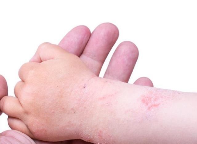 湿疹|宝宝湿疹的3个治疗误区，别再走“弯路”了！