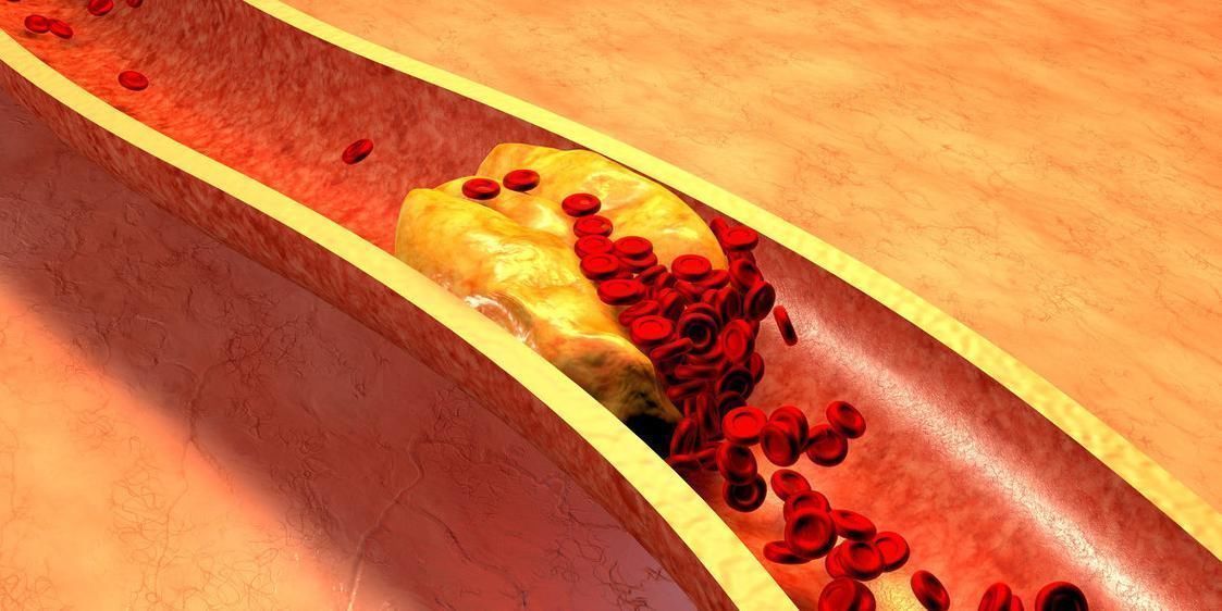 血脂异常|心血管院士开水里加1勺,连喝10天,血管干净、高血脂不攻自破