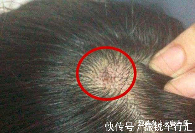 脓包|几天洗一次头最好?头发一湿就用洗发水?几个洗发误区,值得了解