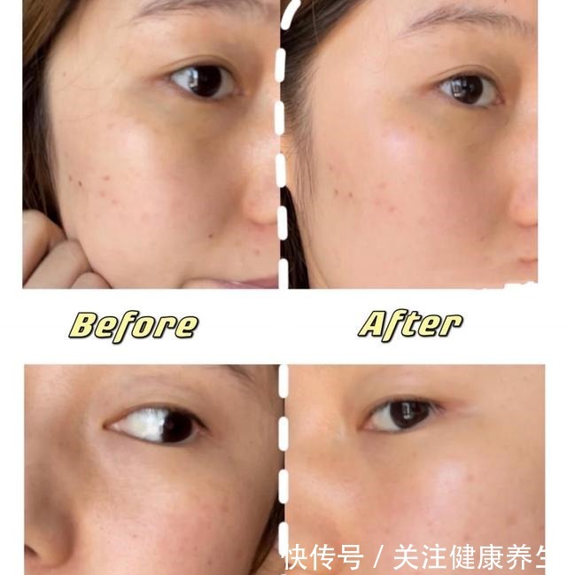 m22 超光子嫩肤真的有那么神奇吗!
