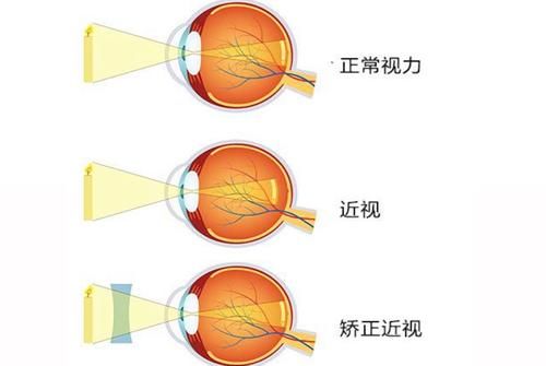 常态环境中，毁掉孩子视力的元凶并非手机电视，而是这四种因素