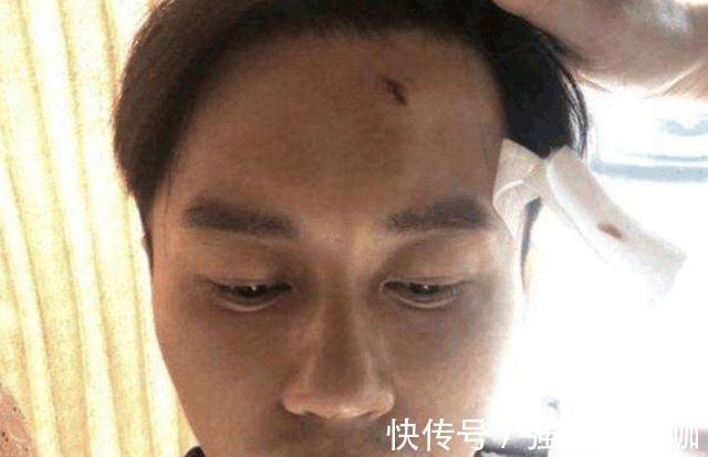 盤點因綜藝節(jié)目受傷的三位明星,李晨只是縫針,他卻因此丟了性命