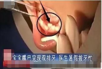 男孩|4岁男孩长出双排牙,只因父母太过“细养”孩子,医生太无知