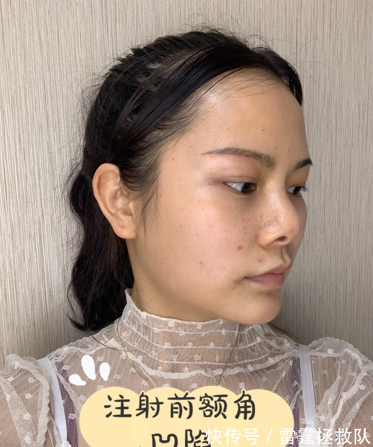 颧骨|太阳穴凹陷、颧骨突出?可能是这个部位造成的!