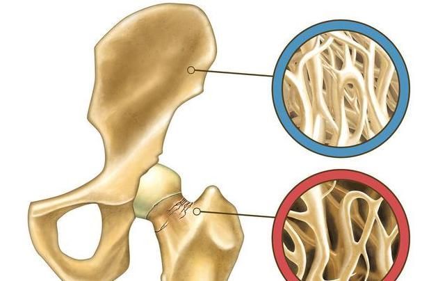 经常性|骨质疏松怎么办?先做到这3点,把骨头慢慢“养”好!老年人记牢