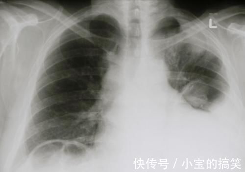 疾病|肺癌最可怕的不是疾病本身，而是伴随的并发症