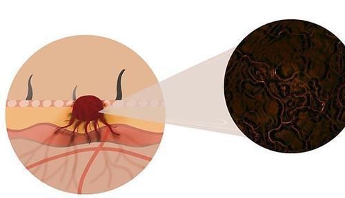 癌细胞|肿瘤专家说癌症是人体“内乱”,轻易别开刀和做筛查,有道理吗?