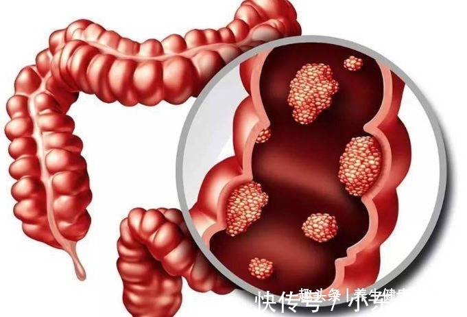 鼻息肉|一个只有四味药的中药方,能消除一切息肉,值得你收藏!