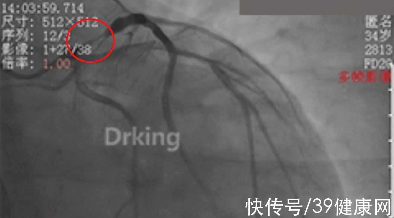 手术|调查曝光：心脏支架降价后，还是有医生滥用，配套检查可能更贵了