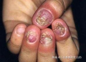 喜欢“啃指甲”的孩子,长大后会变成啥样医生逃不过两个结局