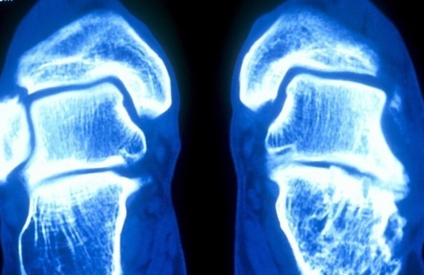 发胖|提醒:孩子出现3个症状,说明长高“瓶颈期”到了,家长别忽视了