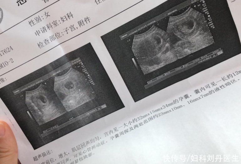 雌激素|23岁女生以为怀孕，却查出子宫内膜癌！医生找到病因，女孩崩溃