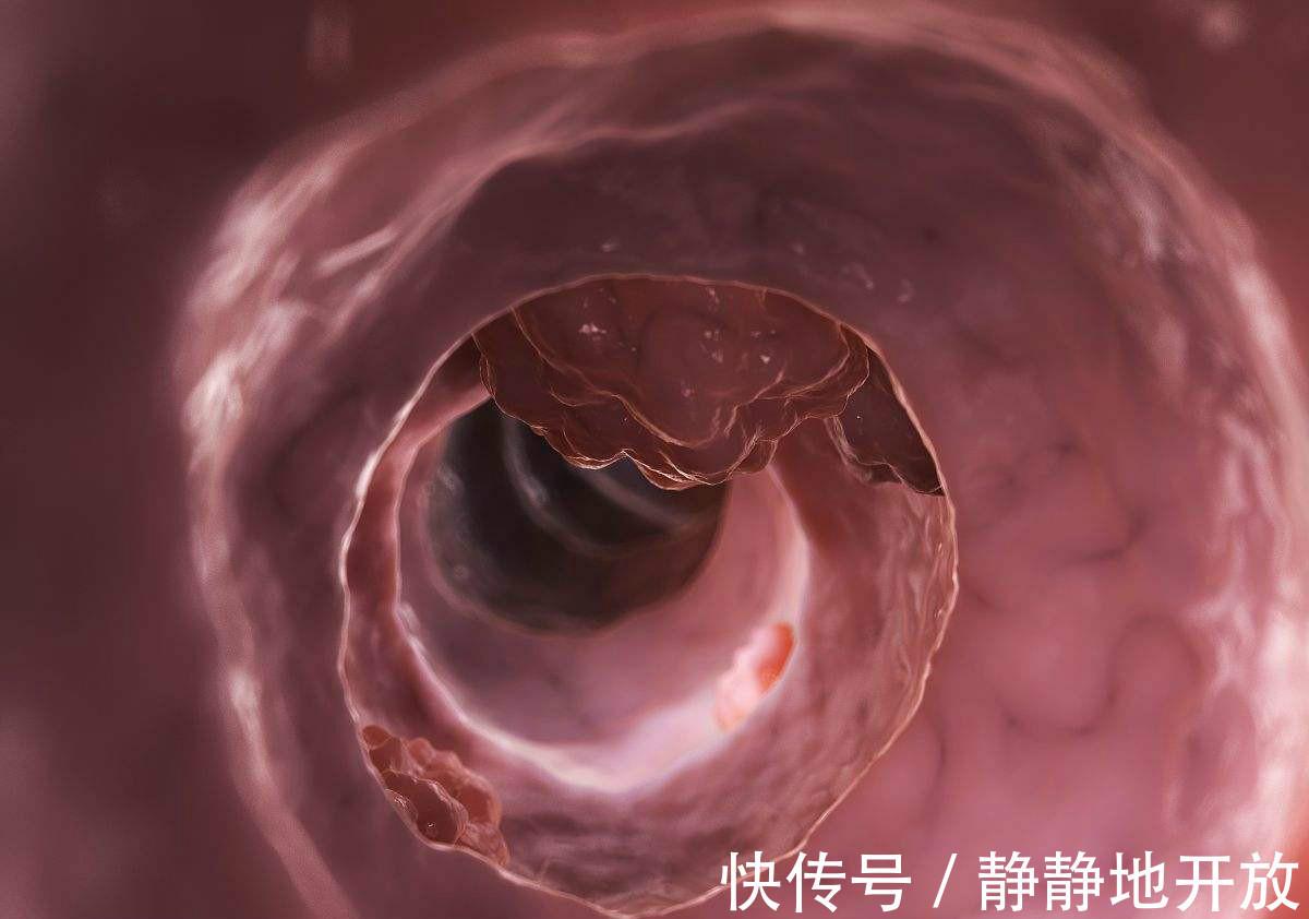 症状|三个症状不断出现,十有八九是大肠癌,最好去检查一下