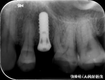 治疗|“看个牙还要拍个X光吃个线?”