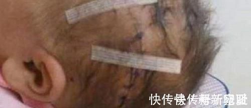 剖腹产|剖腹产划伤孩子头部,医生很快就会好的,7年后家长找上医院