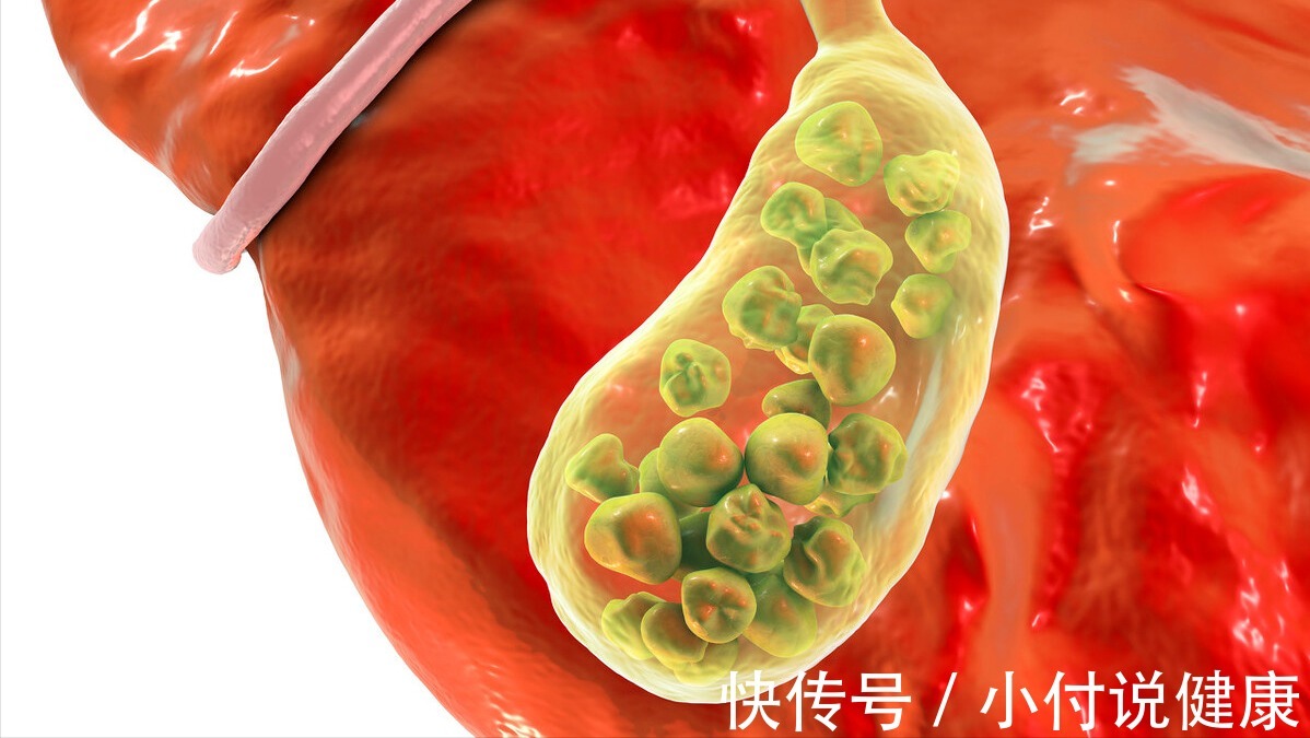 结石|别再把消化不良当胃病!或许是胆囊不好了,听听医生怎么说