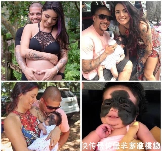 胎记|7个月婴儿脸上因巨大黑色胎记爆红!像带着“蝙蝠侠”面具!
