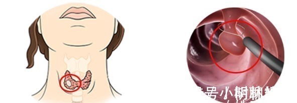 良性|结节、息肉、囊肿、增生哪个最可能癌变这么多年疑惑终于解开了