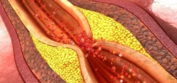 大夫|高血脂大多是“吃”出来的,大夫直言:真正对血脂好的是此5物!