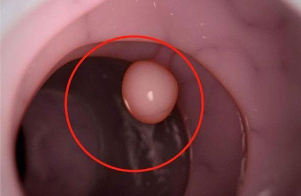 体检|年过50想长寿，要留心身上的4个“小凸起”，离癌症近的人才会有