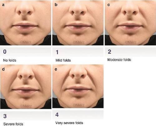 项目|我想祛除法令纹,医美的诸多项目,该如何选择?