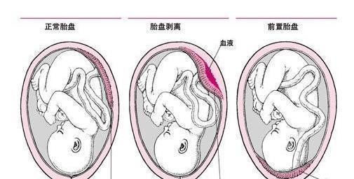 阴道出血|如果孕期发现这5种异常出血情况，立刻去医院！