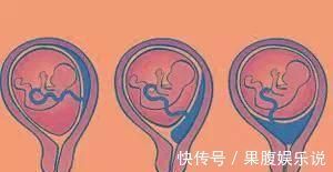 宫颈|分娩时,出现以下8种情况的产妇务必选择剖腹产,千万别犹豫误事