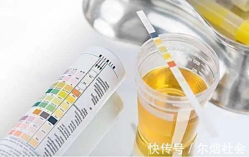 尿白蛋白|糖尿病患者出现哪些症状,说明发生了肾脏损害?重点观察两项指标