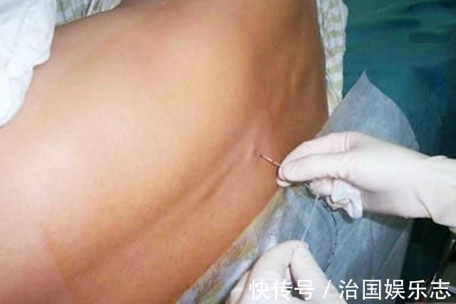 宝妈|九张剖腹产手术全过程图片,那些说生孩子容易的人好好看看