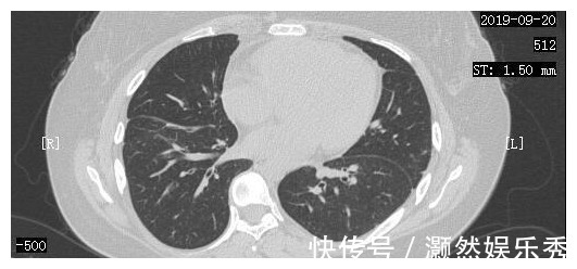 癌细胞|23岁女孩癌细胞全身扩散，一年抗癌出奇迹