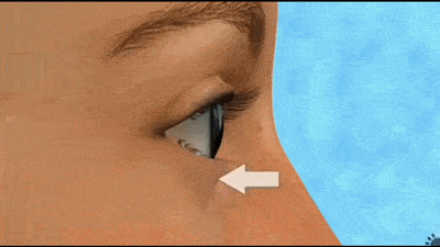 都是去除多余的脂肪，为什么大腿吸脂不容易反弹，而去眼袋会反弹？