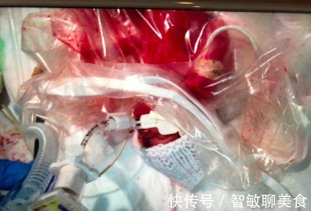 外科医生|英国妇女在怀孕21周时生下一个孩子宝宝是透明的，可以看到体内的血液流动
